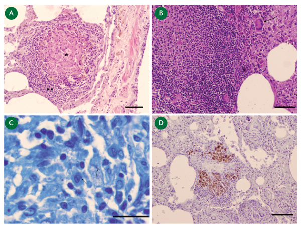 Figura 2. Lesiones histológicas en tejón infectado con M. bovis. © Ana Balseiro. SERIDA 2011. A) Granuloma tuberculoso en pulmón formado por células epiteliodes (*) y por linfocitos y macrófagos (**) Hematoxilina-Eosina, Barra = 50 µm.B) Granuloma en el que se pueden observar células gigantes de Langhans (flecha). Hematoxilina-Eosina, Barra = 50 µm.C) Bacilos acido-alcohol resistentes (flechas). Ziehl-Neelsen, Barra = 20 µm. D) Positividad mediante tinción inmunohistoquímica en macrófagos en un granuloma en pulmón. Peroxidasa anti-Peroxidasa, Barra = 100 µm.